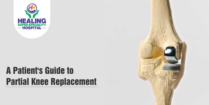 A Patient’s Guide to Partial Knee Replacement